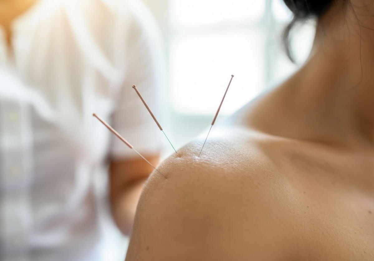 Akupunkturnadeln werden in der Schulter eingesetzt, um Schmerzen zu lindern, die Beweglichkeit zu verbessern und die Lebensqualität bei orthopädischen Beschwerden zu steigern.